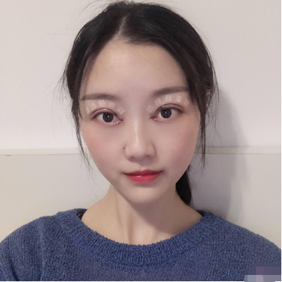 上海九院整形科蘇薇潔雙眼皮怎么樣？真實(shí)案例和價格表一起瞧瞧~