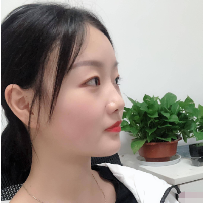 上海九院整形科蘇薇潔雙眼皮怎么樣？真實(shí)案例和價格表一起瞧瞧~