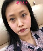 北京八大處滕利顴骨修復(fù)怎么樣？分享案例效果照片及價格表一覽