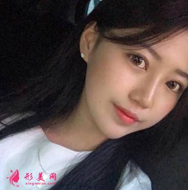 北京聯(lián)合麗格第一醫(yī)院雙眼皮案例分享！附2022價(jià)格表