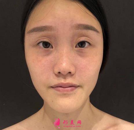 武漢同濟(jì)醫(yī)院整形科隆鼻怎么樣？附術(shù)后案例及價(jià)格表一覽~