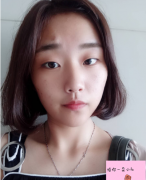 上海九院蘇薇潔雙眼皮怎么樣?附雙眼皮前后對(duì)比案例分享