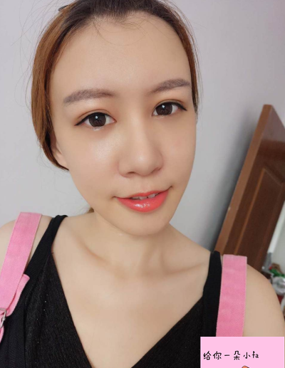 北京純脂馮斌脂肪填充怎么樣?看看術(shù)后效果怎么樣?