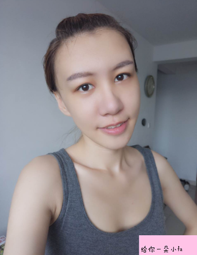 北京純脂馮斌脂肪填充怎么樣?看看術(shù)后效果怎么樣?