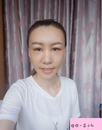 北京純脂馮斌脂肪填充怎么樣?看看術(shù)后效果怎么樣?