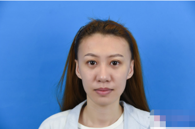 北京純脂馮斌脂肪填充怎么樣?看看術(shù)后效果怎么樣?