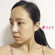 西安第二附屬醫(yī)院整形科隆鼻修復案例和價格費用更新上線～