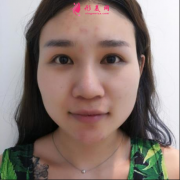 北京圣嘉榮有磨骨資質嗎？正規(guī)嗎？磨骨案例及價格表