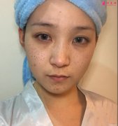 西安西京激光祛斑效果好不好？來看激光治療斑點消失的過程吧