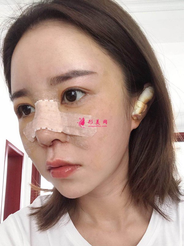 上海華美醫(yī)療美容醫(yī)院徐文龍醫(yī)生膨體隆鼻案例