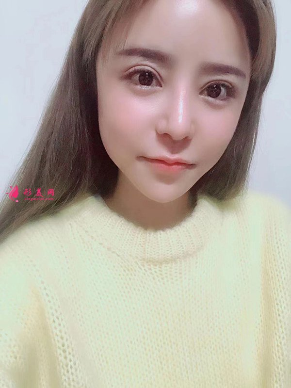 上海華美醫(yī)療美容醫(yī)院徐文龍醫(yī)生膨體隆鼻案例