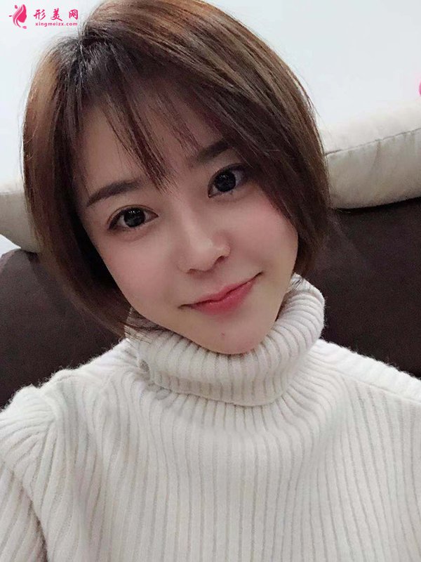 上海華美醫(yī)療美容醫(yī)院徐文龍醫(yī)生膨體隆鼻案例