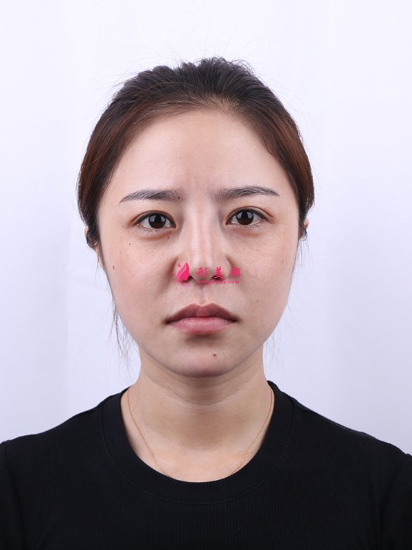 上海華美醫(yī)療美容醫(yī)院徐文龍醫(yī)生膨體隆鼻案例