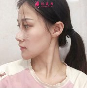 上海九院整形科價格2021均價_附隆鼻案例效果反饋