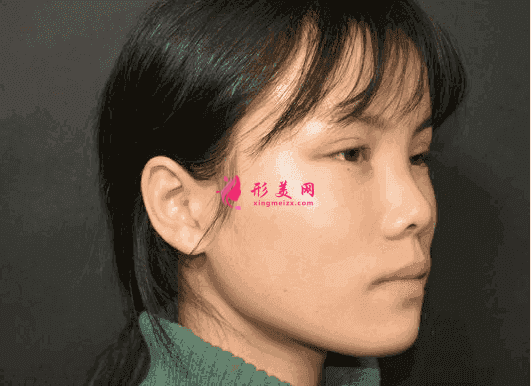 南昌時光整形是三甲醫(yī)院嗎？附玻尿酸隆鼻效果對比及2021價格表發(fā)布