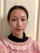 重慶北部寬仁醫(yī)院2021價(jià)格表曝光+下頜角整形日記分享