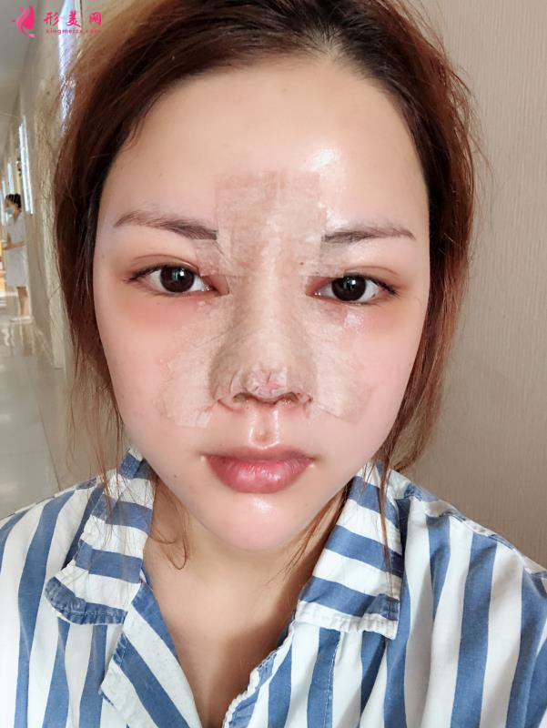 北京八大處隆鼻價格表一覽及隆鼻真人案例分享 北京八大處隆鼻價格表一覽及隆鼻真人案例分享