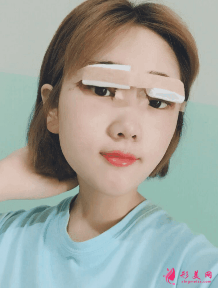北京八大處雙眼皮多少錢？雙眼皮前后圖片對比+2021價(jià)格表曝光