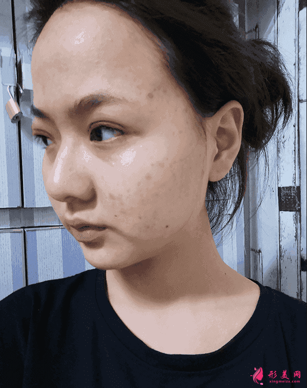 北京三院雙眼皮價(jià)格？附雙眼皮案例及2021價(jià)格表公開