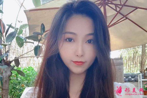 武漢玻尿酸豐下巴手術(shù)效果分享 術(shù)后 武漢玻尿酸豐下巴手術(shù)效果分享