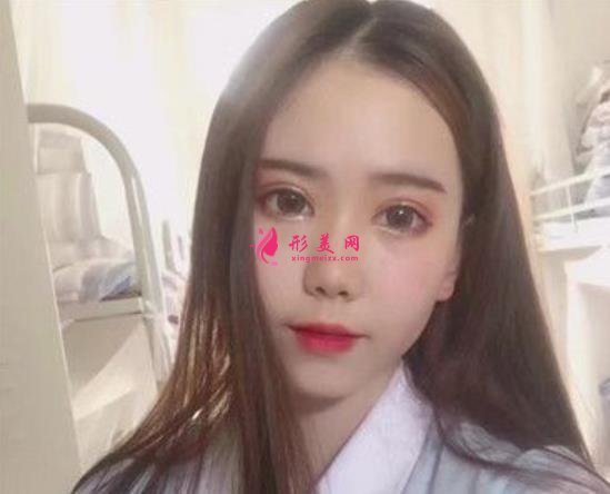 河北省二院雙眼皮手術(shù)好嗎？小仙女術(shù)后真實(shí)恢復(fù)效果圖一覽