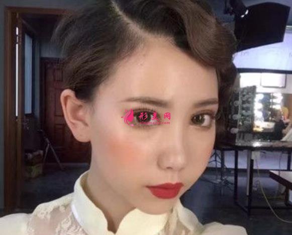 河北省二院雙眼皮手術(shù)好嗎？小仙女術(shù)后真實(shí)恢復(fù)效果圖一覽