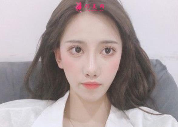 河北省二院雙眼皮手術(shù)好嗎？小仙女術(shù)后真實(shí)恢復(fù)效果圖一覽