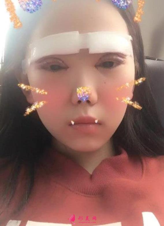河北省二院雙眼皮手術(shù)好嗎？小仙女術(shù)后真實(shí)恢復(fù)效果圖一覽