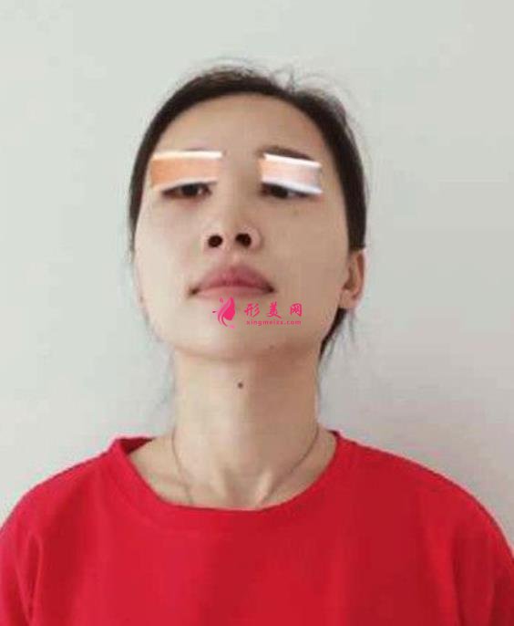 山西省眼科醫(yī)院雙眼皮好不好？小姐姐分享術(shù)后三個(gè)月恢復(fù)效果圖