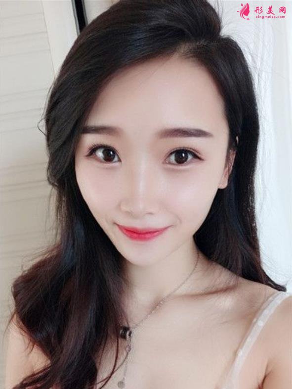 山西省眼科醫(yī)院雙眼皮好不好？小姐姐分享術(shù)后三個(gè)月恢復(fù)效果圖