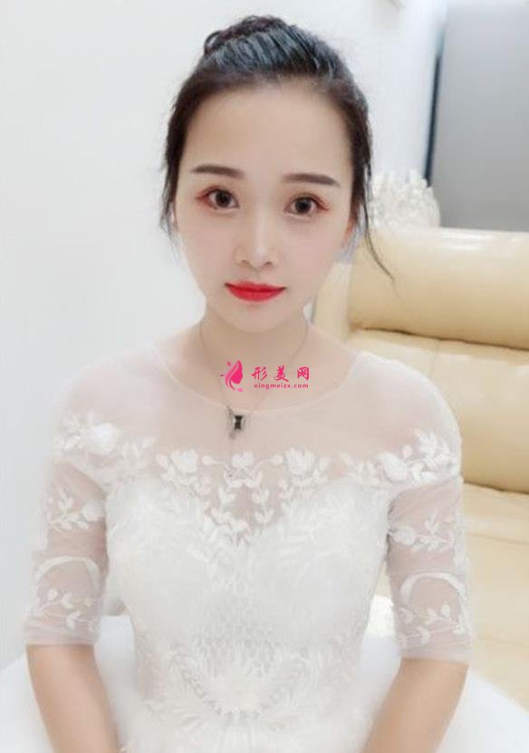 山西省眼科醫(yī)院雙眼皮好不好？小姐姐分享術(shù)后三個(gè)月恢復(fù)效果圖