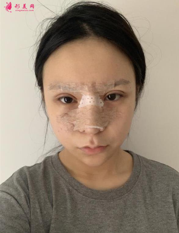 南京友誼醫(yī)院整形科隆鼻案例術(shù)后恢復(fù)過程分享！含全新醫(yī)美價格表