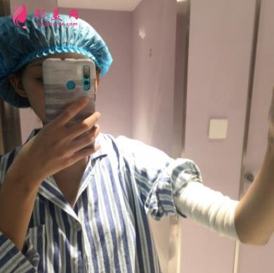 河北工程大學(xué)附屬醫(yī)院整形外科手臂抽脂案例分享！含吸脂價(jià)格表公開