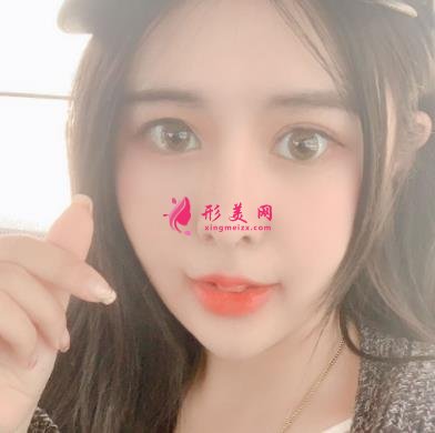 北京煤醫(yī)整形醫(yī)院做面部吸脂瘦臉怎么樣？看完案例效果圖你肯定心動(dòng)~~