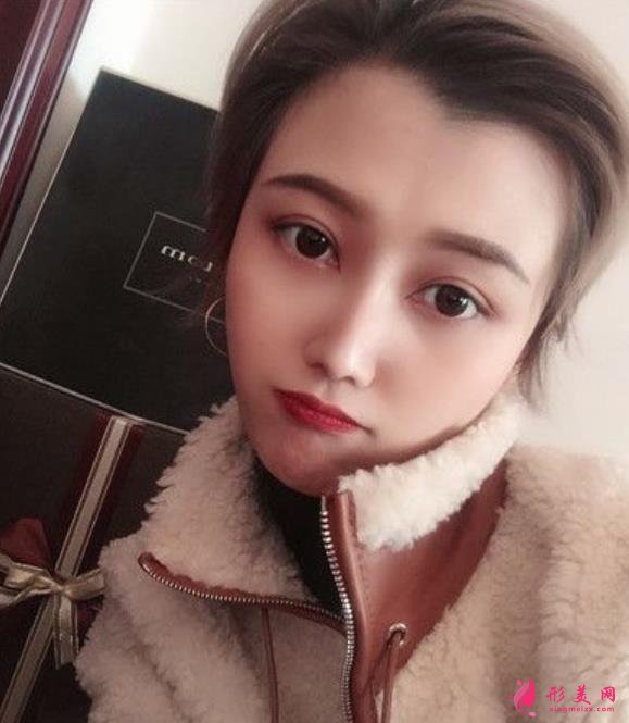 南京醫(yī)科大整形醫(yī)院埋線雙眼皮好嗎？無P圖美顏案例在此