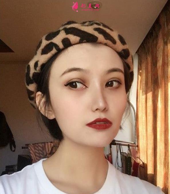 南京醫(yī)科大整形醫(yī)院埋線雙眼皮好嗎？無P圖美顏案例在此