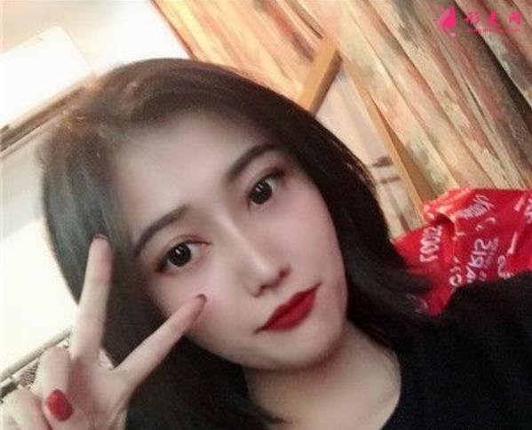 南京醫(yī)科大整形醫(yī)院埋線雙眼皮好嗎？無P圖美顏案例在此