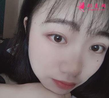汕頭市中心醫(yī)院整形科價格收費詳情及做雙眼皮效果大揭秘
