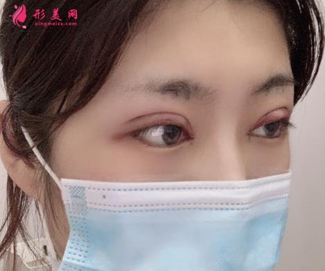 佛山市第一人民醫(yī)院美容科好嗎？雙眼皮案例及價格收費表公開對比
