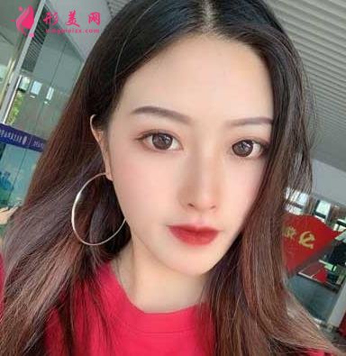 重醫(yī)附二院整形科怎么樣？快來參考埋線雙眼皮案例及價格價目表