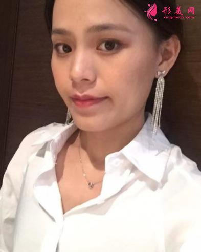 福州海峽美容醫(yī)院去眼袋怎么樣？技術(shù)特色、案例、價格收費雙雙公開