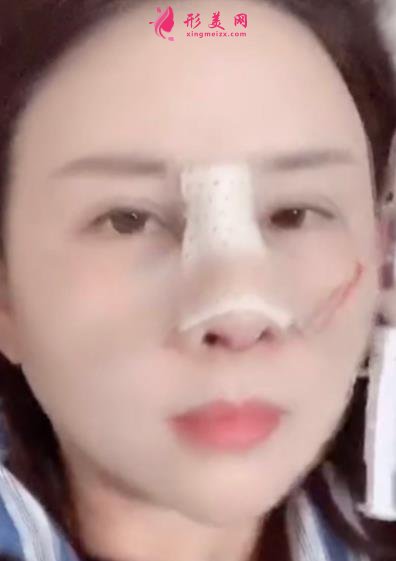 南京鼻祖整形醫(yī)院怎么樣？案例前后變化圖及隆鼻價(jià)格價(jià)目表分享