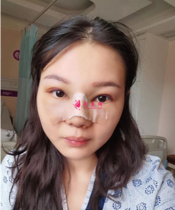 廣東省第二人民醫(yī)院整形美容科做隆鼻怎么樣？看專家案例價(jià)格查詢