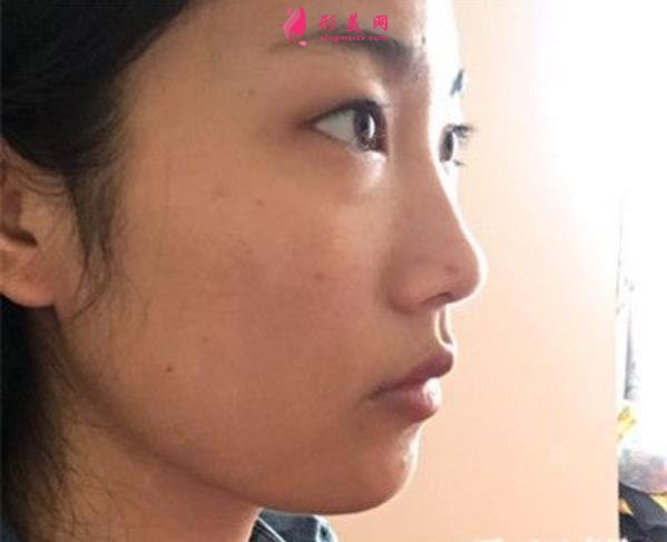 貴州省人民醫(yī)院瘦臉針價(jià)格公示，醫(yī)美老司機(jī)吐血分享，全是干貨