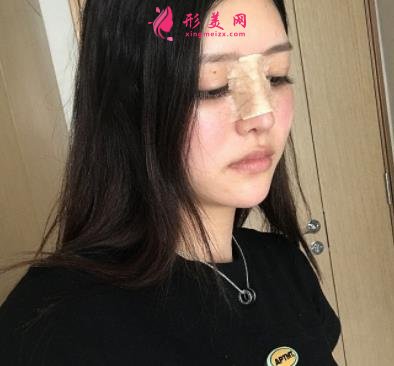 鄭大一附院整形科做鼻子怎么樣？醫(yī)生案例及價(jià)格價(jià)目表公開反饋