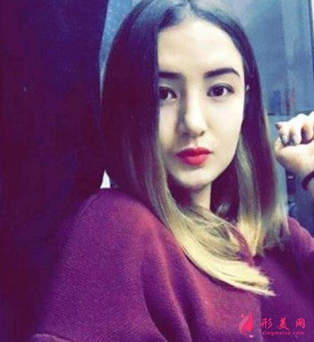 河南整形醫(yī)院鼻綜合恢復(fù)過程分享，不化妝無美顏不修圖的案例在此
