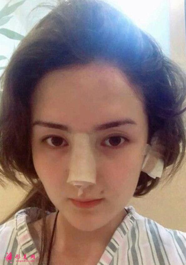 河南整形醫(yī)院鼻綜合恢復(fù)過程分享，不化妝無美顏不修圖的案例在此