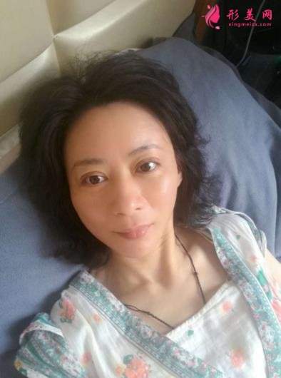 北京瑞麗馮立哲多維拉面部提升怎么樣？案例及效果圖公開查詢