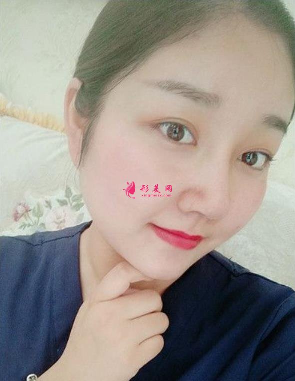 滁州鼓樓醫(yī)院鼻綜合怎么樣？術(shù)后效果隆鼻的整形醫(yī)生笑哭了！