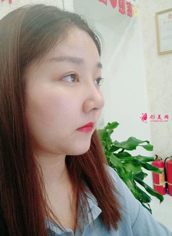 滁州鼓樓醫(yī)院鼻綜合怎么樣？術(shù)后效果隆鼻的整形醫(yī)生笑哭了！